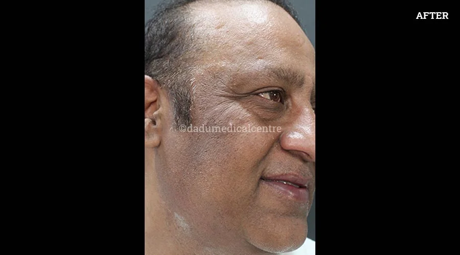 Acanthosis Nigricans - after