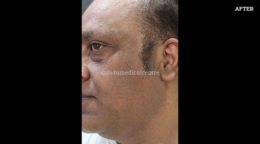 Acanthosis Nigricans - after