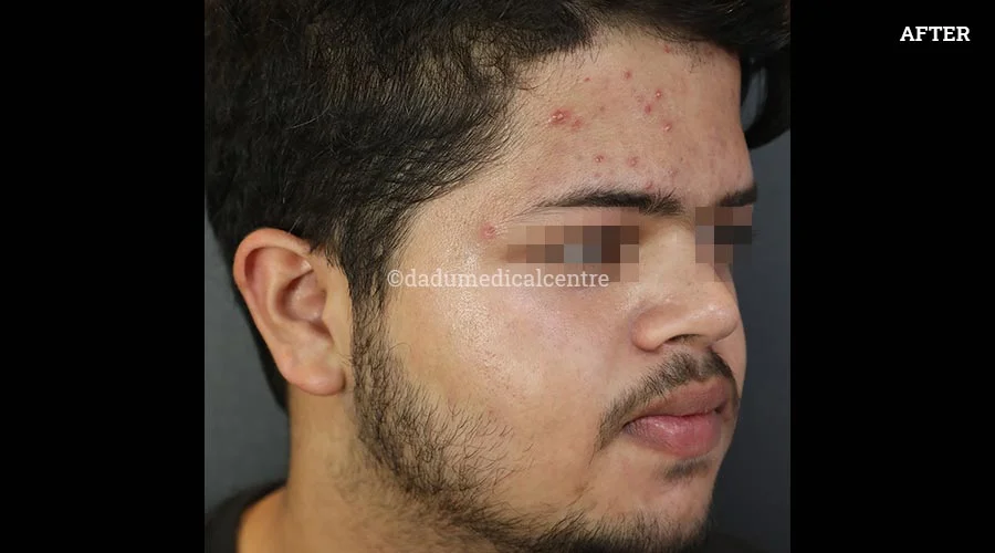 DMC-Acne Check Peel - after