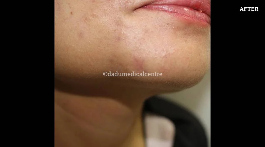 acne ZAP - after