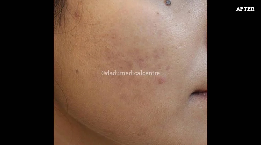 DMC-Acne Check Peel - after