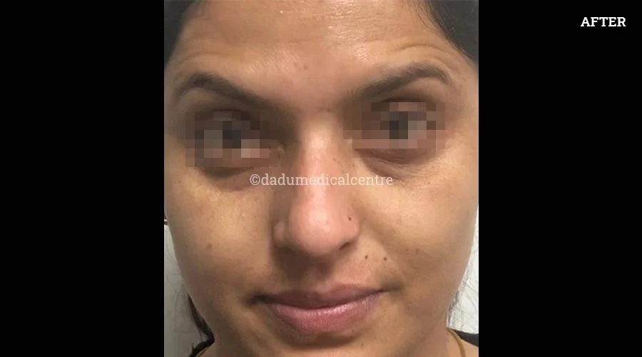 Anti-Wrinkle Injection - after