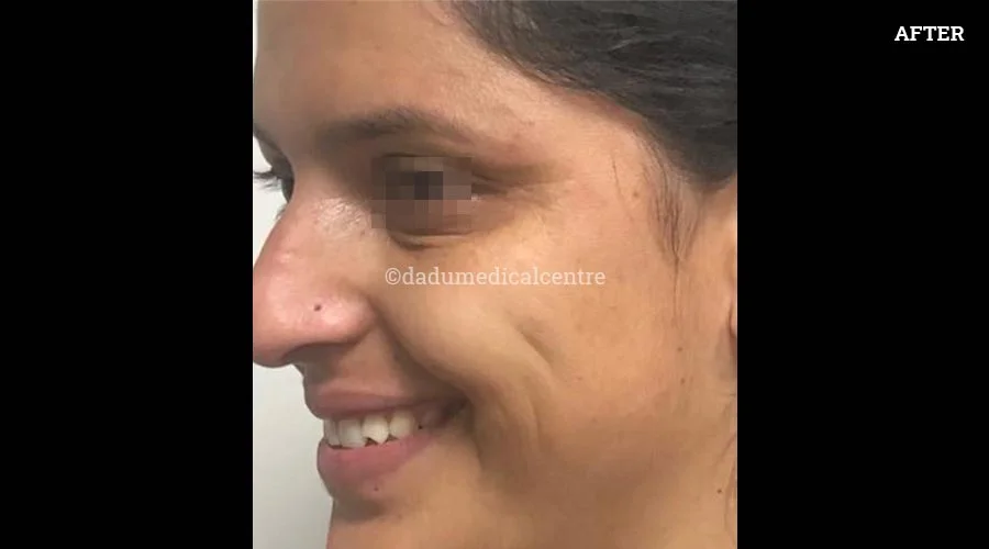 Anti-Wrinkle Injection - after