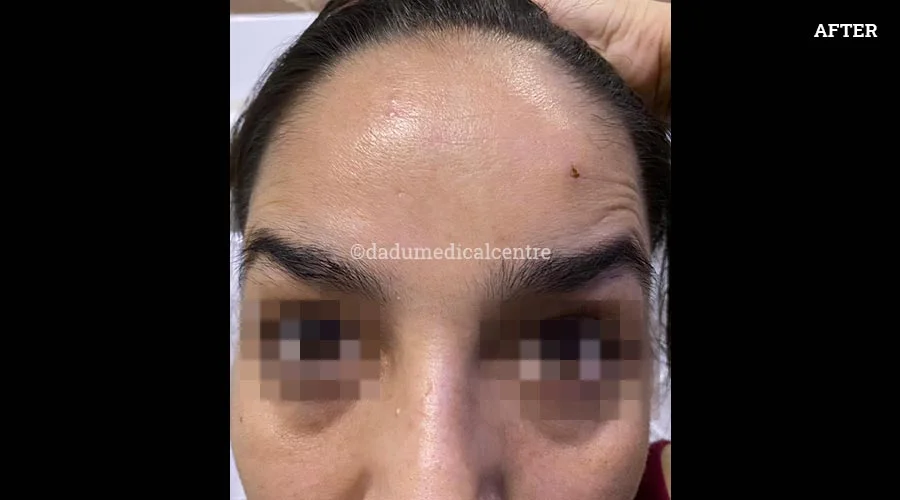 Forehead Lift - after