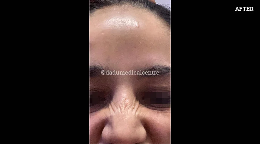 Forehead Lift - after
