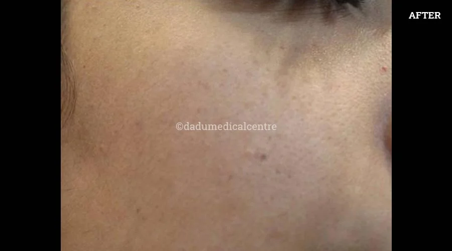 Freckles - after