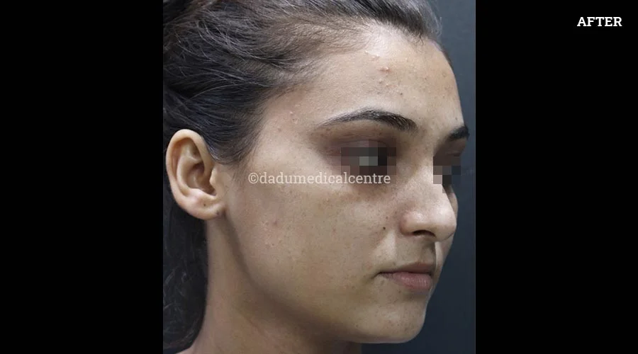 Freckles - after
