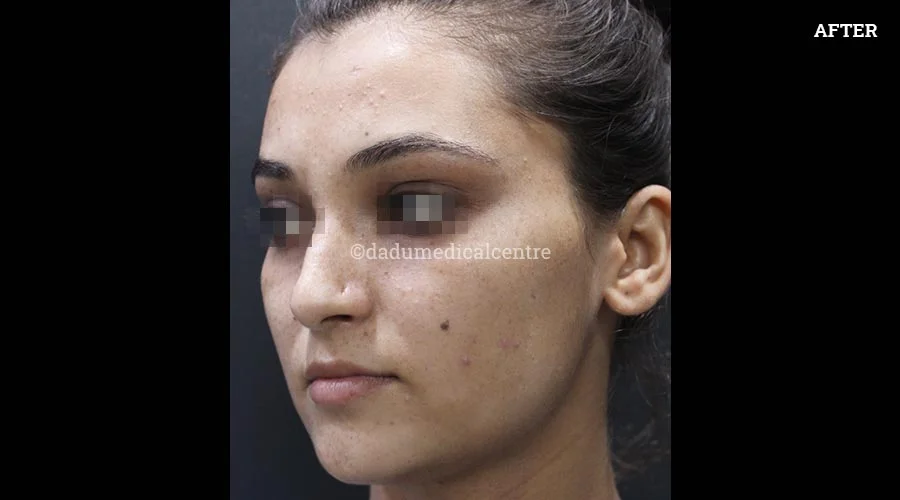 Freckles - after