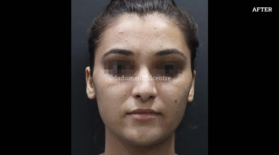 Freckles - after