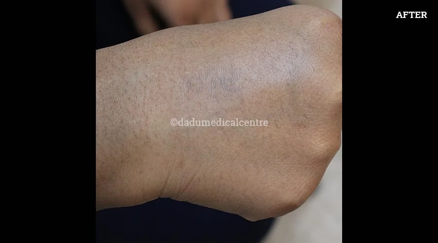 Laser Tattoo Removal - after
