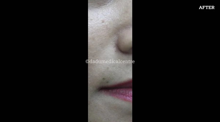 Mole Removal - after