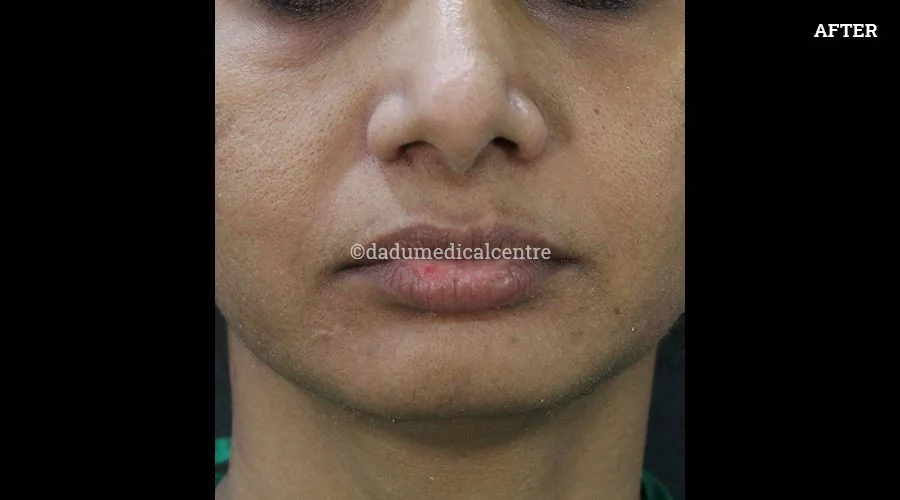Nasolabial Folds - after