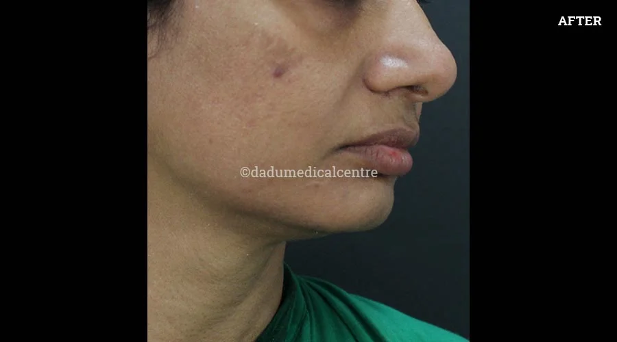 Nasolabial Folds - after