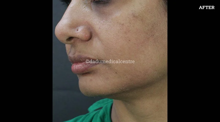 Nasolabial Folds - after