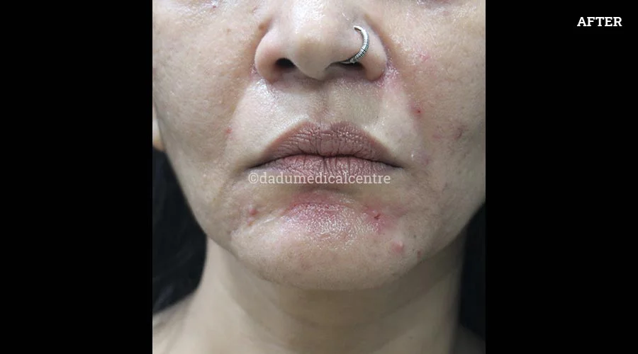 Nasolabial Folds - after