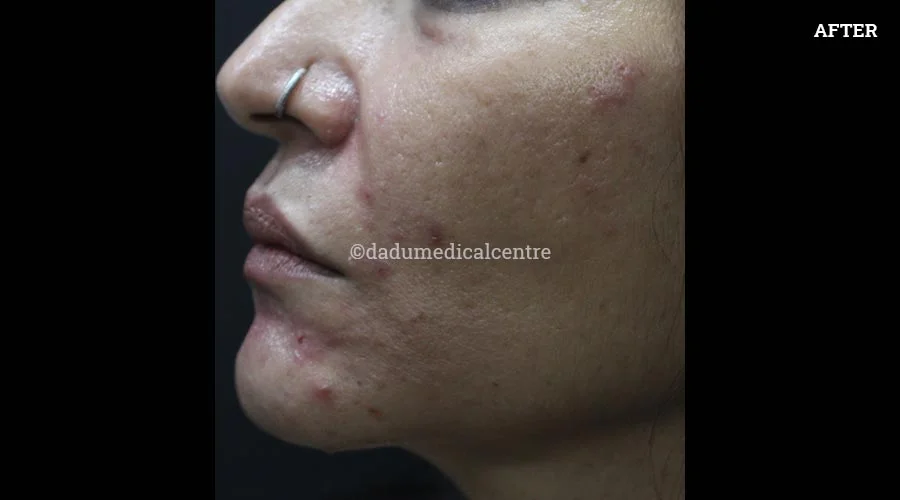 Nasolabial Folds - after