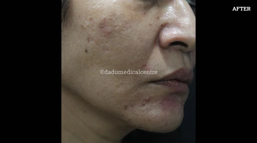 Nasolabial Folds - after