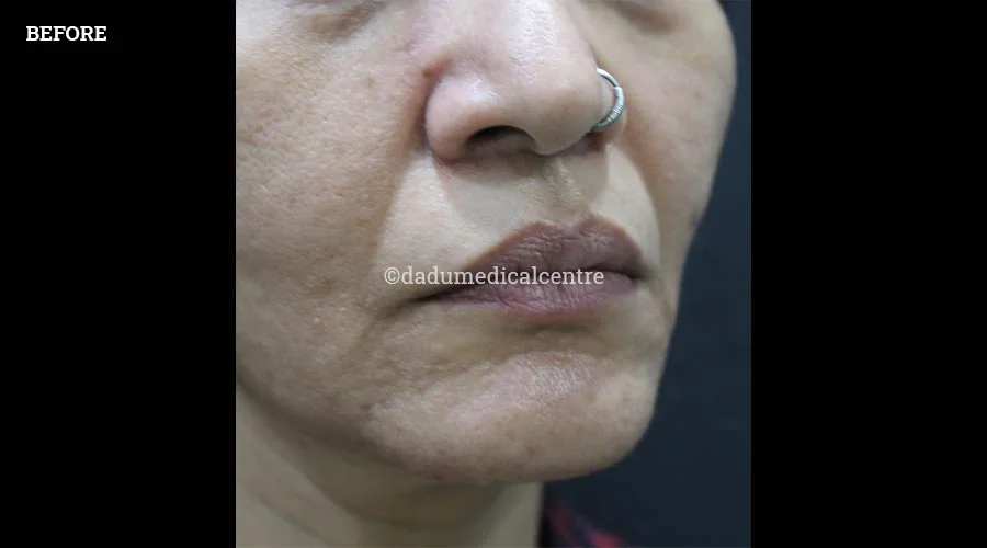 Nasolabial Folds - before