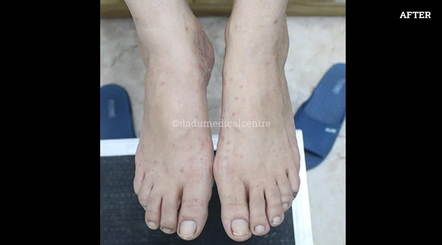Psoriasis - after