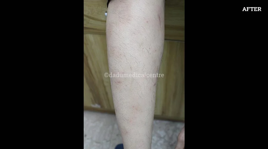Psoriasis - after