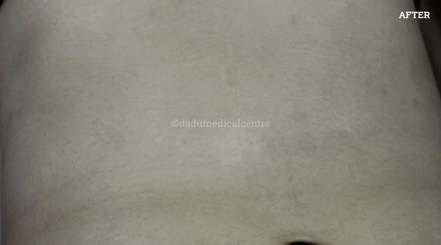 Stretch Marks - after