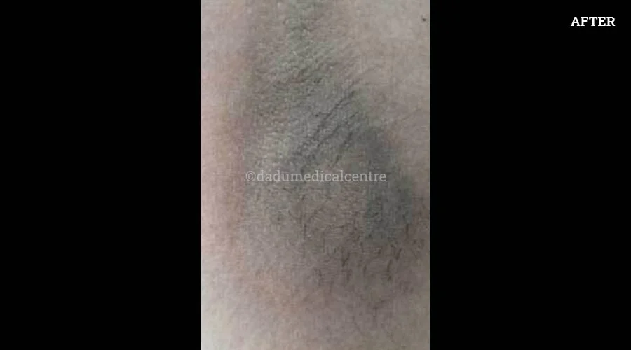 Under Arms - after