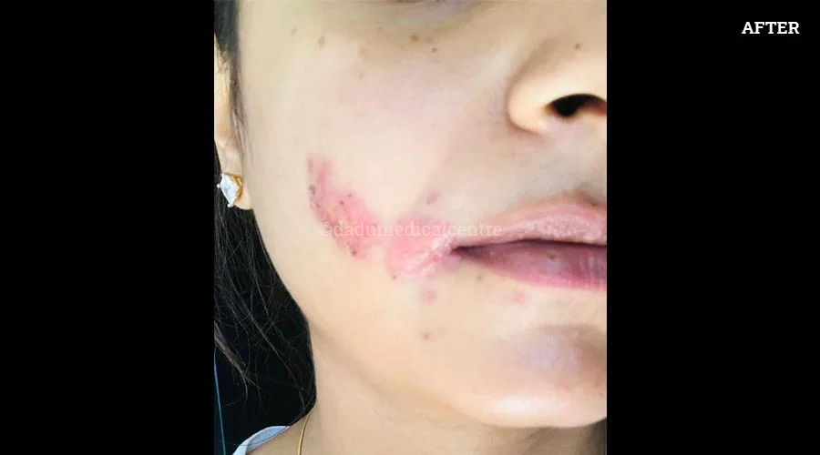 Urticaria - after