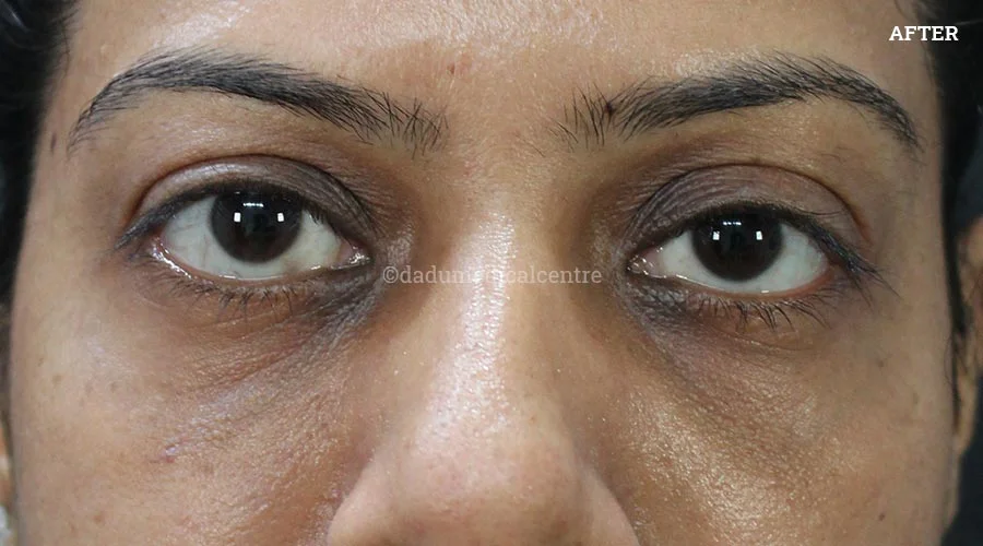 Dark Circles - after