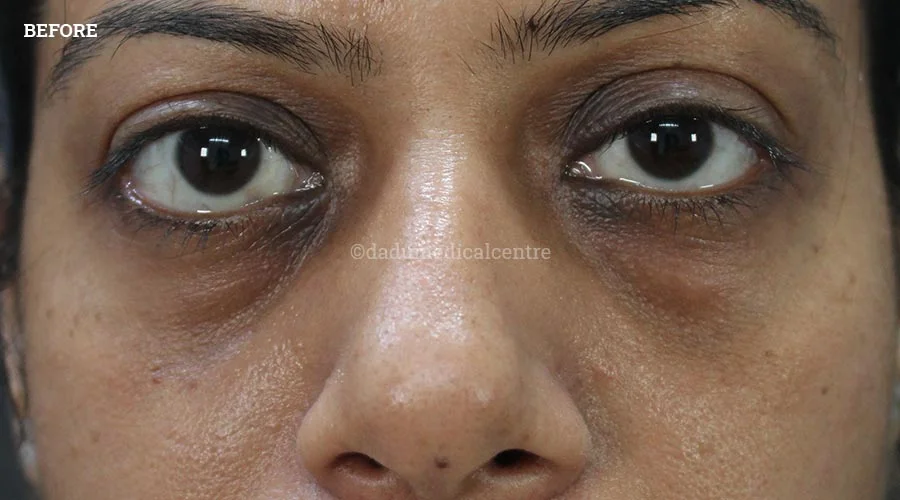Dark Circles - before