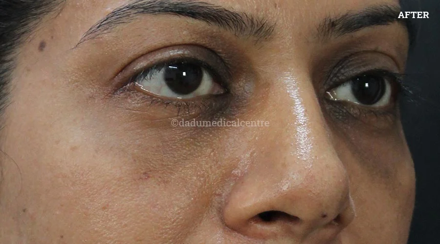 Dark Circles - after
