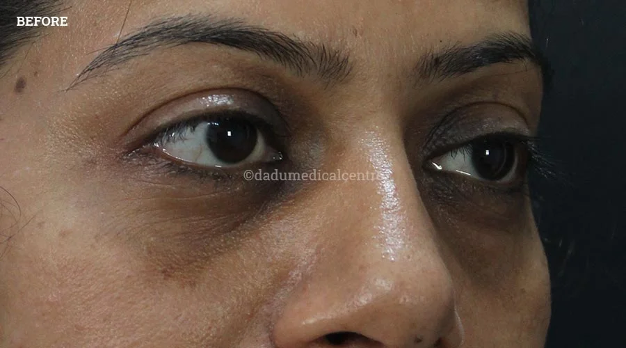 Dark Circles - before