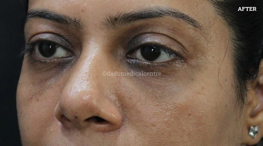 Dark Circles - after