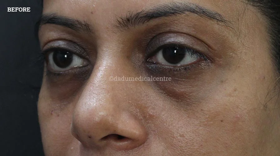 Dark Circles - before