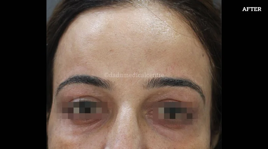 Anti-Wrinkle Injection - after