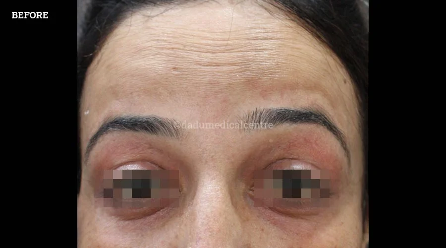 Anti-Wrinkle Injection - before