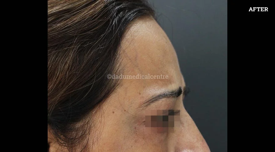 Anti-Wrinkle Injection - after