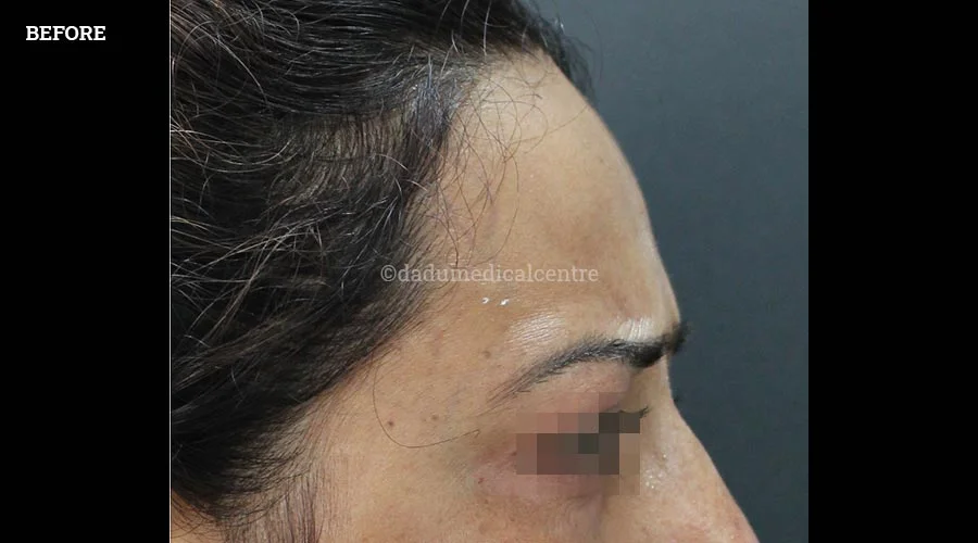 Anti-Wrinkle Injection - before