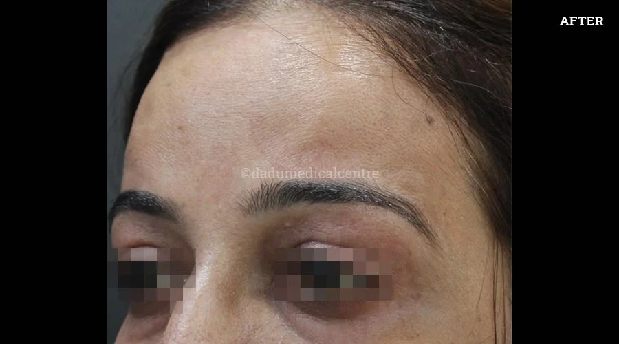 Anti-Wrinkle Injection - after
