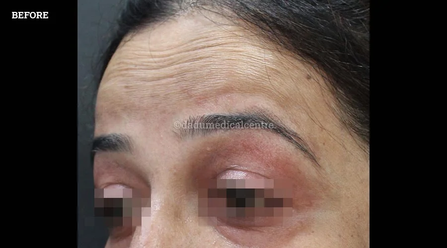 Anti-Wrinkle Injection - before