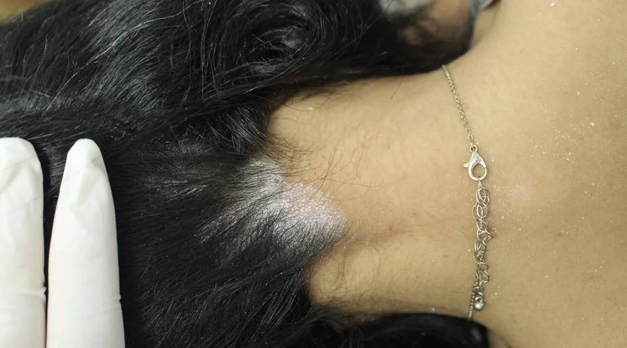 Dandruff - before