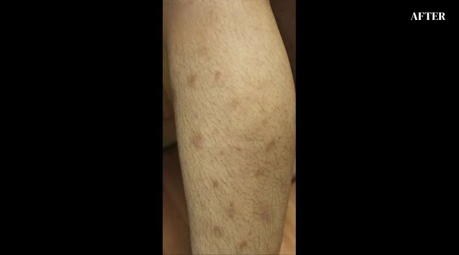 Psoriasis - after
