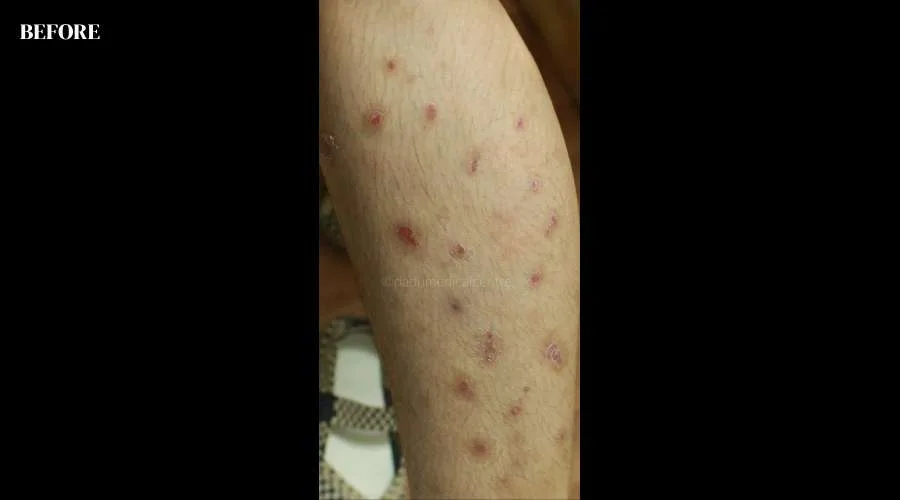 Psoriasis - before