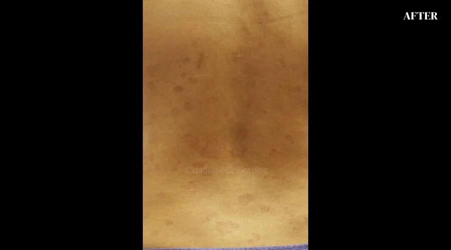 Psoriasis - after