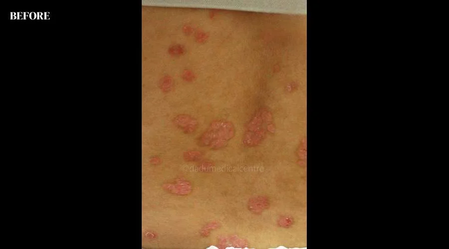 Psoriasis - before