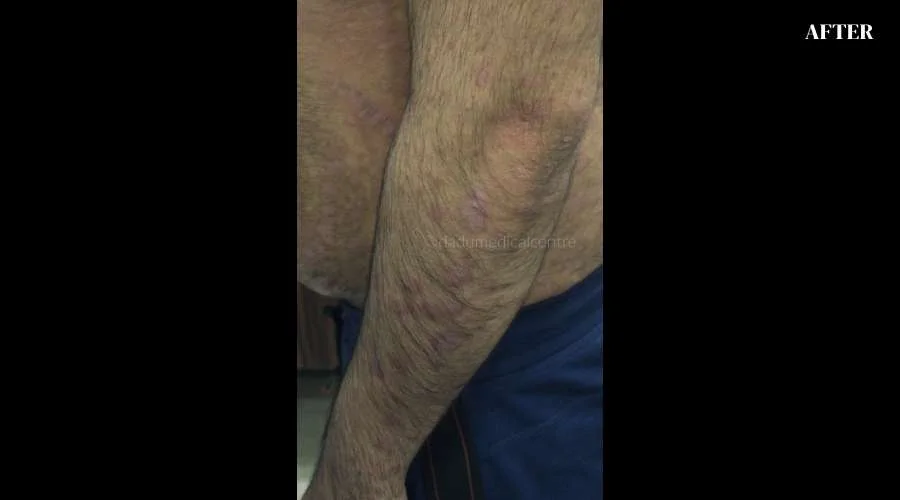 Psoriasis - after