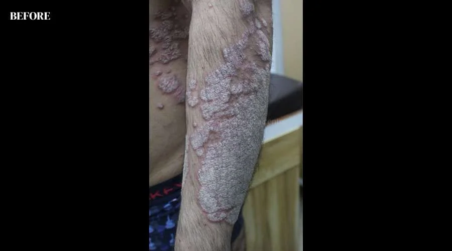 Psoriasis - before