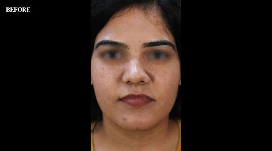 Freckles - before