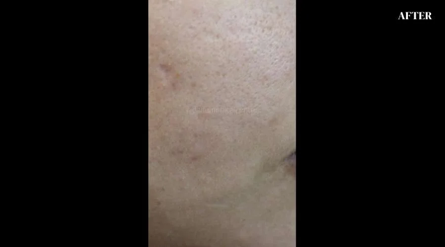 Freckles - after