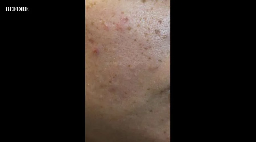 Freckles - before