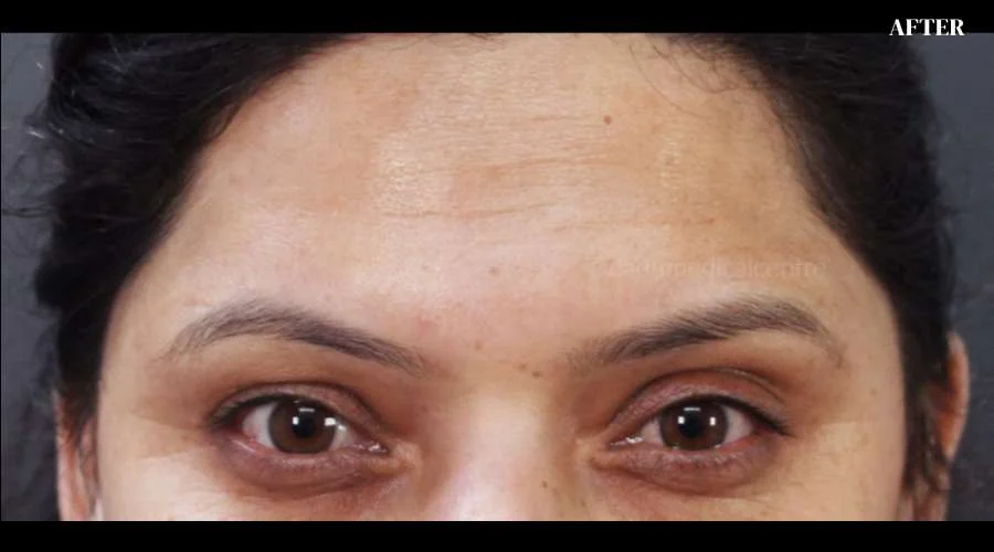 Forehead Lines - after